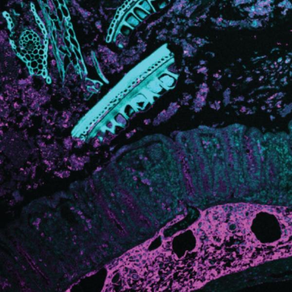 Crohn's-type fibrosis - thickening of the intestinal wall